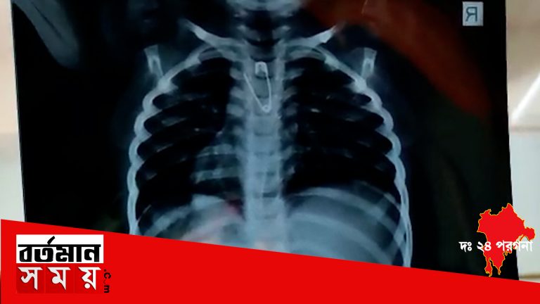 অস্ত্রোপচার করে শিশুর খাদ্যনালীতে আটকে থাকা সেফটি পিন বের করলো চিকিৎসকেরা।