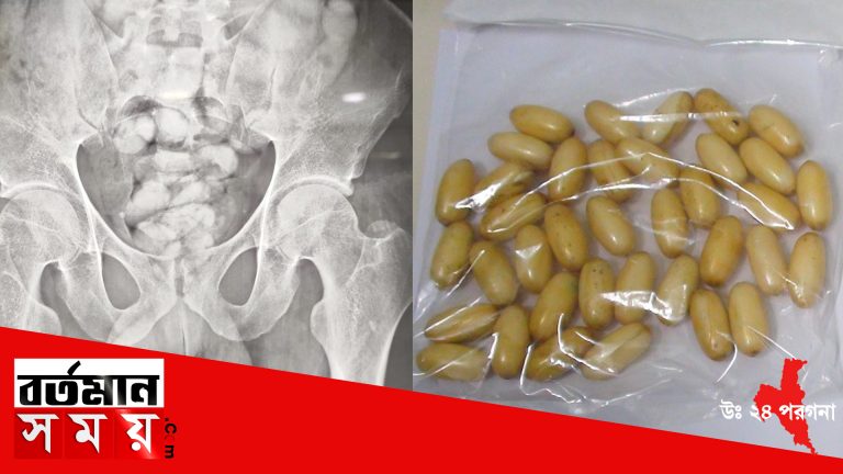 পেটে অসহ্য যন্ত্রণা,এক্সরে করতেই সন্দেহভাজন ব্যক্তির রিপোর্টে চাঞ্চল্যকর তথ্য।