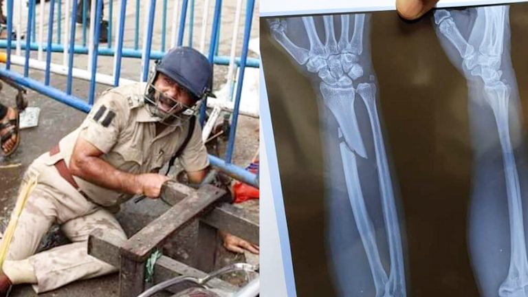 বিজেপির নবান্ন অভিযানে গুরুতর আহত পুলিশকর্মী।