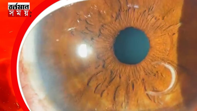 মহিলার ডান চোখের মনির পাশে রয়েছে একটি আস্ত কৃমি !