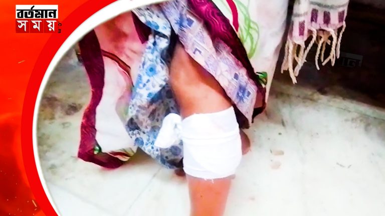 নবদ্বীপে কুকুরের কামড়ে আহত মহিলা সহ ১২